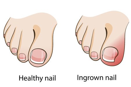 How To Prevent Ingrown Toenail