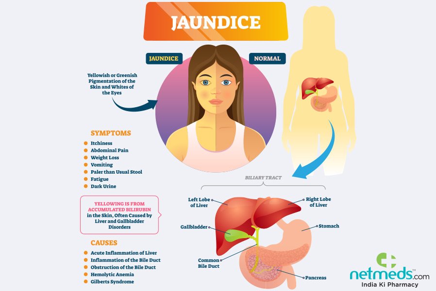 How To Prevent Jaundice
