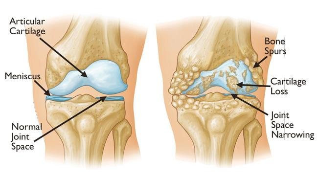 How To Prevent Knee Replacement Surgery