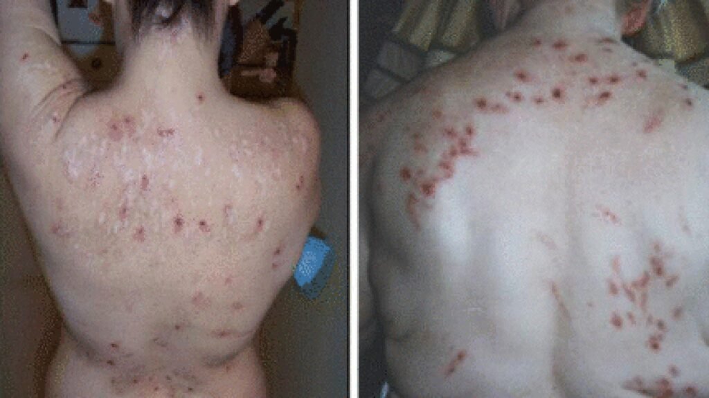 How To Prevent Morgellons