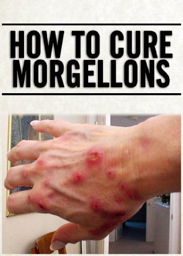How To Prevent Morgellons