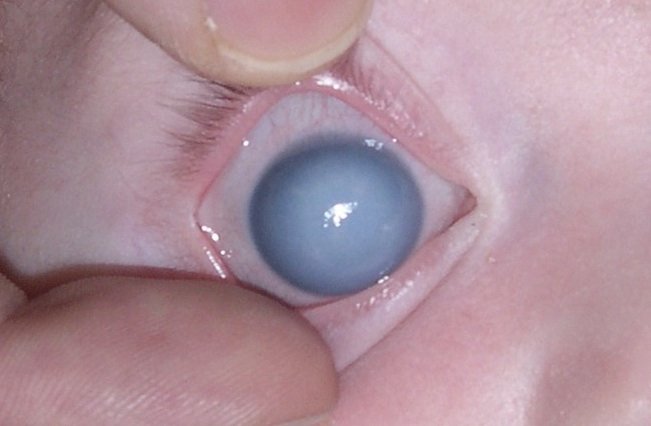How To Prevent Primary Congenital Glaucoma