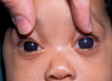 How To Prevent Primary Congenital Glaucoma