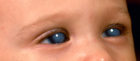 How To Prevent Primary Congenital Glaucoma
