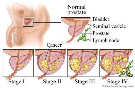 How To Prevent Prostate Cancer