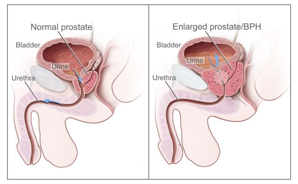 How To Prevent Prostate Cancer
