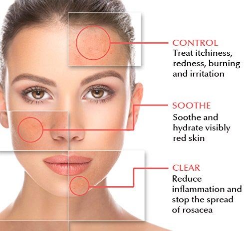 How To Prevent Rosacea How To Prevent Rosacea
