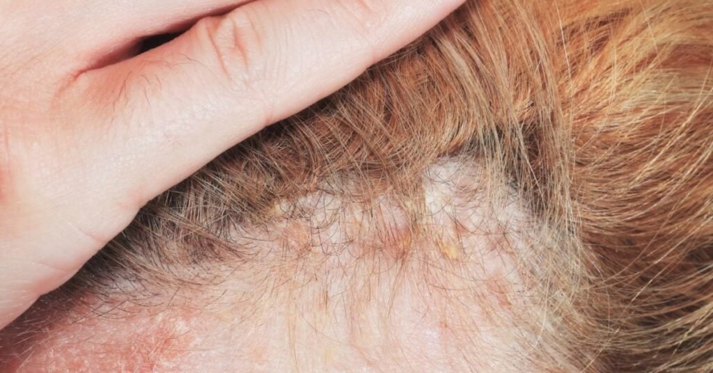 How To Prevent Scalp Psoriasis
