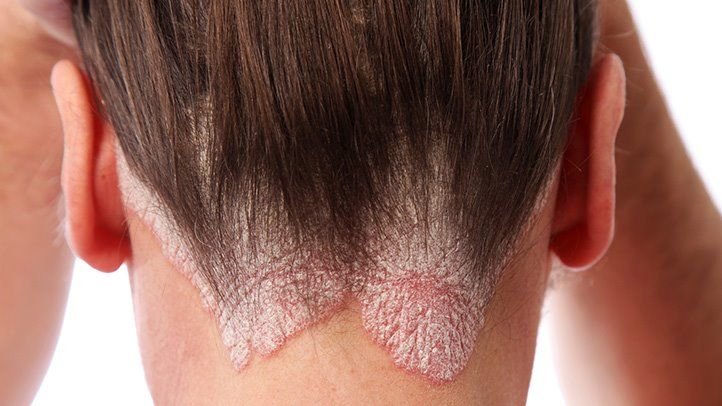 How To Prevent Scalp Psoriasis