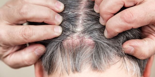How To Prevent Scalp Psoriasis