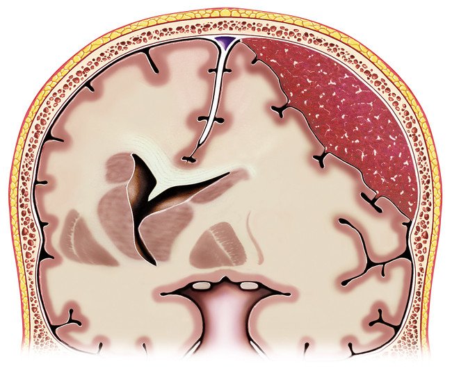 How To Prevent Subdural Hematoma How To Prevent Subdural Hematoma