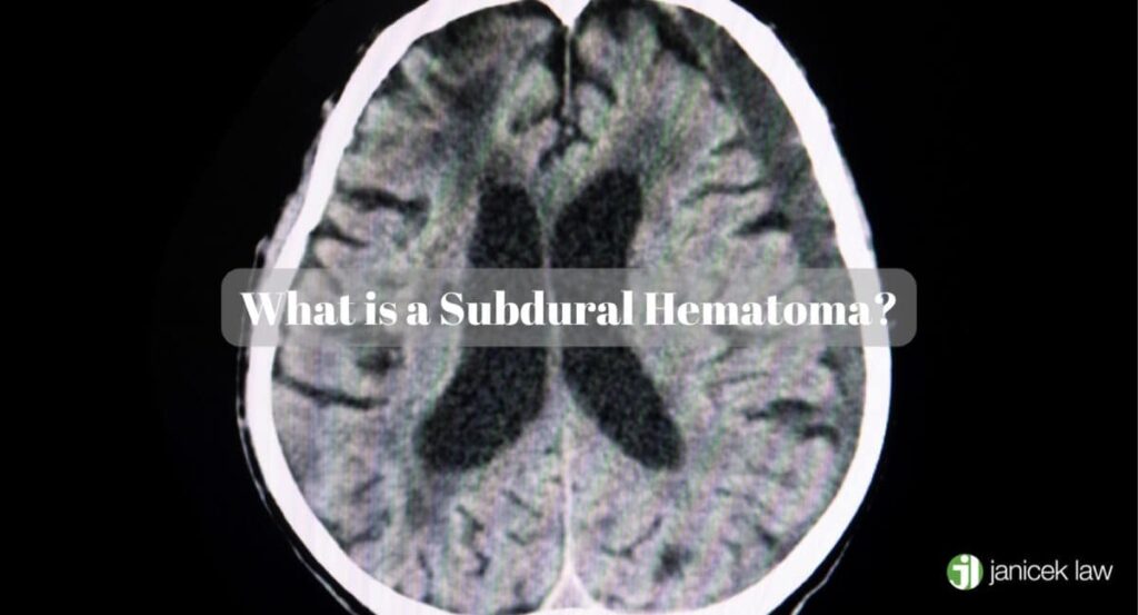 How To Prevent Subdural Hematoma How To Prevent Subdural Hematoma