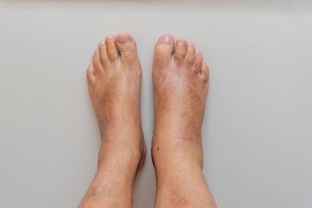 How To Prevent Swollen Feet Or Ankles