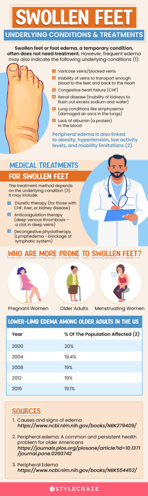 How To Prevent Swollen Feet Or Ankles