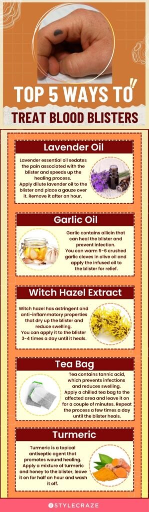 How to Treat Blisters and Prevent Infections