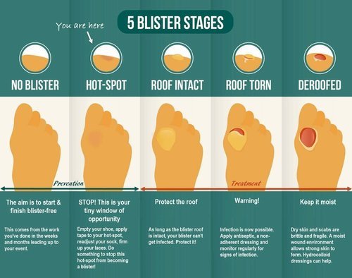 How to Treat Blisters and Prevent Infections