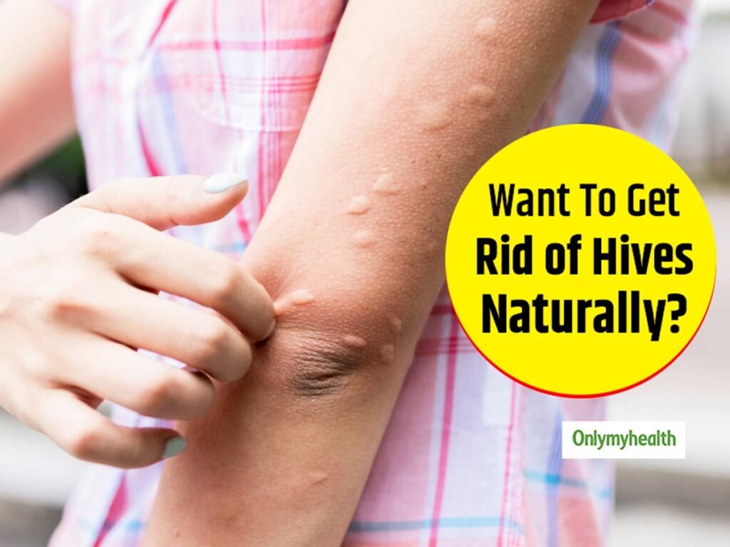 How to Treat Hives: Effective Remedies and Tips How to Treat Hives: Effective Remedies and Tips