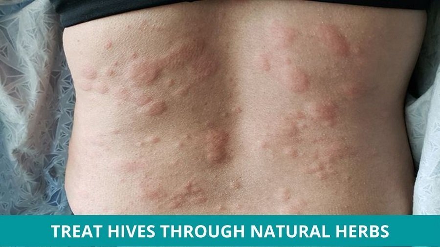 How to Treat Hives: Effective Remedies and Tips How to Treat Hives: Effective Remedies and Tips
