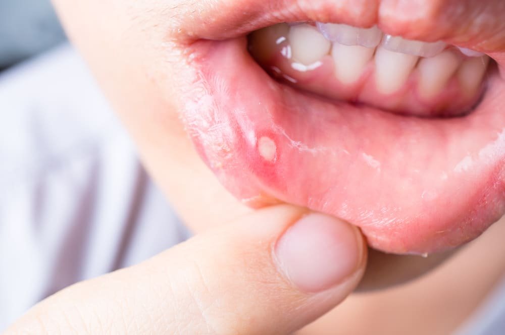 How to Treat Mouth Ulcers Naturally
