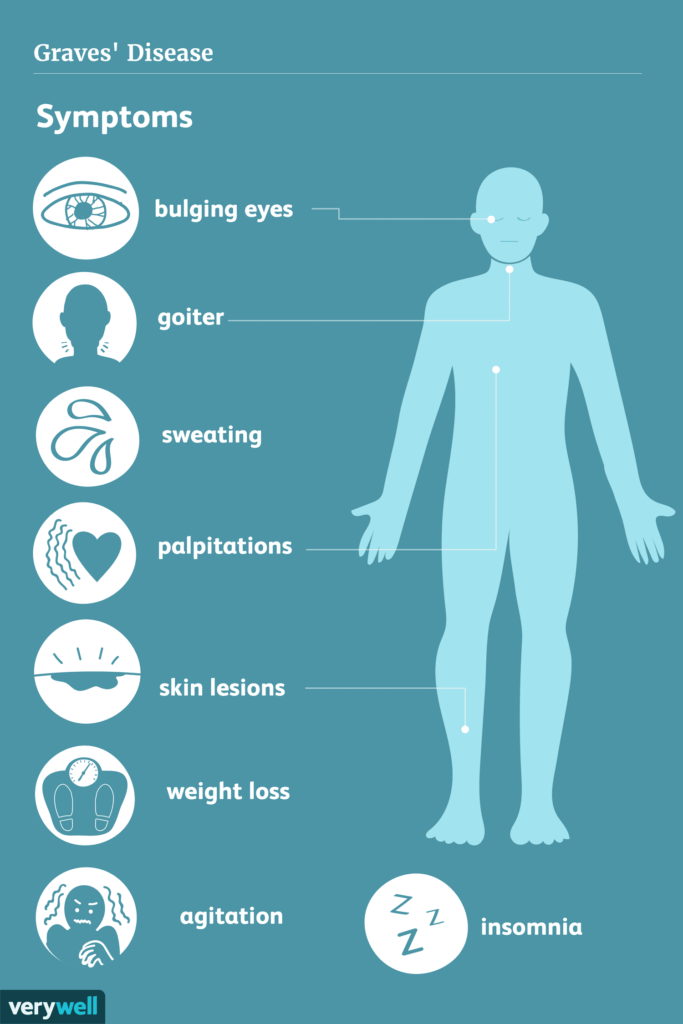 Hyperthyroidism 101: What You Need to Know