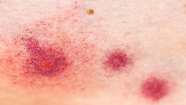 Identifying and Avoiding Allergic Reactions to Insect Bites