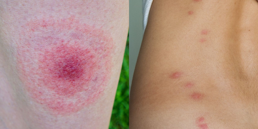 Identifying and Avoiding Allergic Reactions to Insect Bites