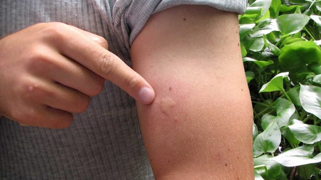 Identifying and Avoiding Allergic Reactions to Insect Bites