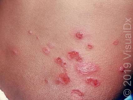Impetigo: A Comprehensive Guide for Parents and Caregivers