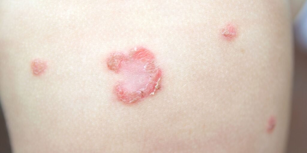 Impetigo: A Comprehensive Guide for Parents and Caregivers