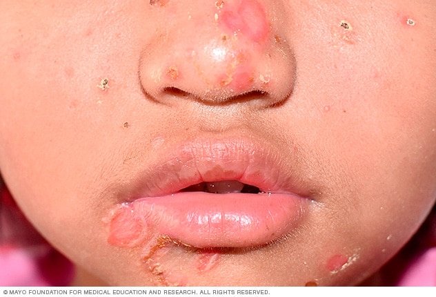 Impetigo: A Comprehensive Guide for Parents and Caregivers