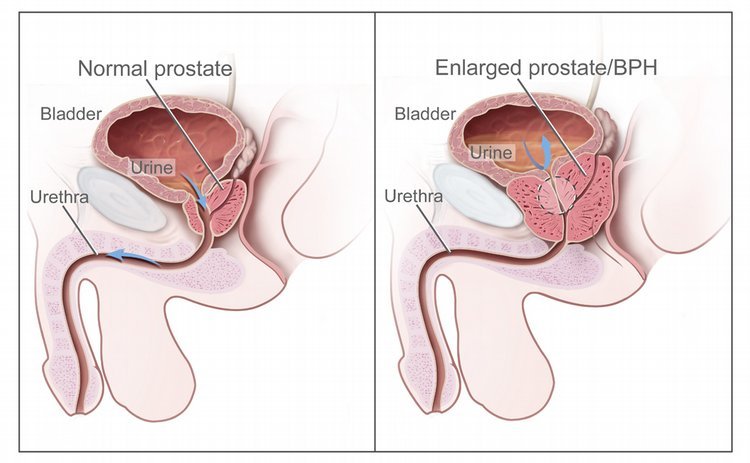 Important Nursing Considerations for Enlarged Prostate