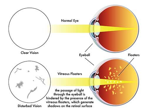 Important Nursing Considerations for Eye Floaters and Eye Flashes