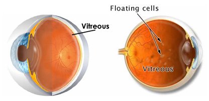 Important Nursing Considerations for Eye Floaters and Eye Flashes
