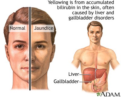 Jaundice and Liver Health: What You Need to Know