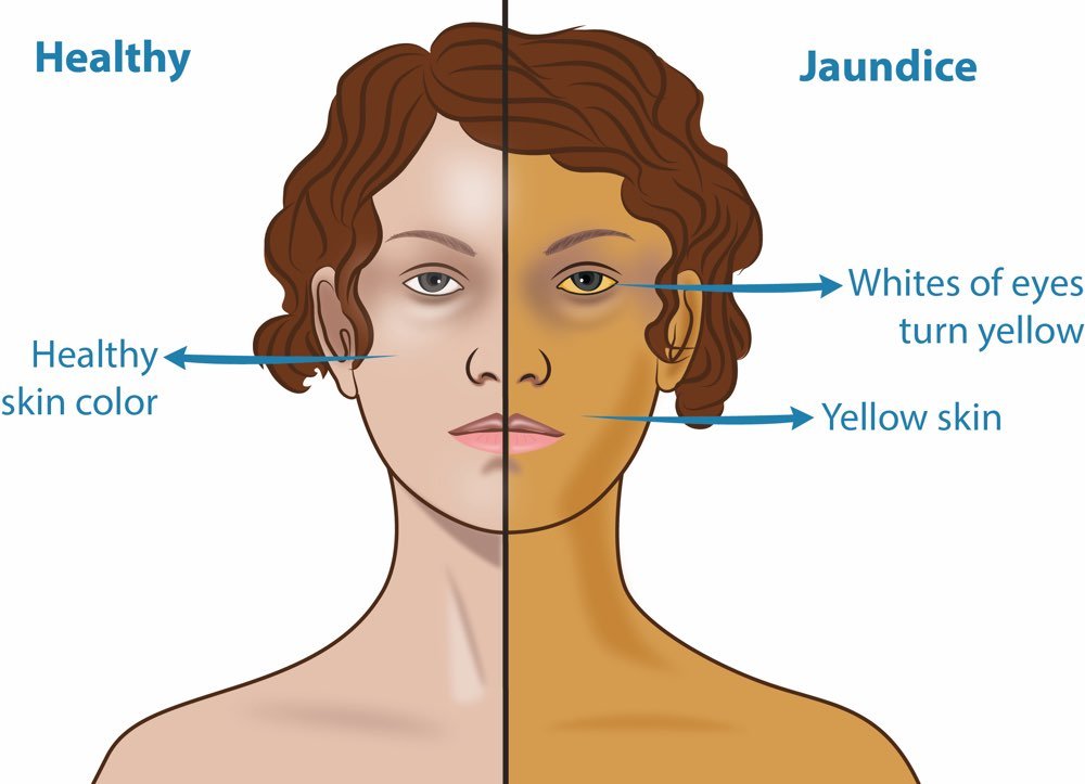Jaundice and Liver Health: What You Need to Know