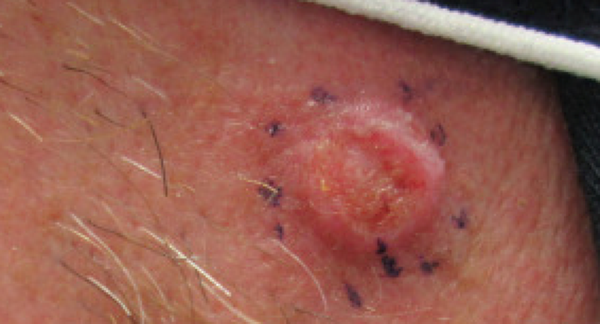 Key Nursing Considerations For Skin Cancer-Wrinkles - Ask The Nurse Expert
