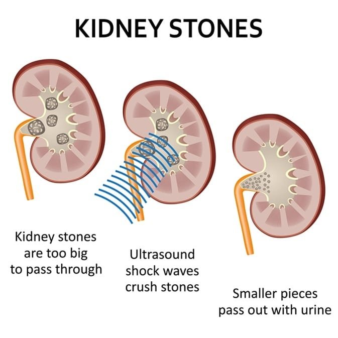 Kidney Stones: Symptoms and Treatment Options