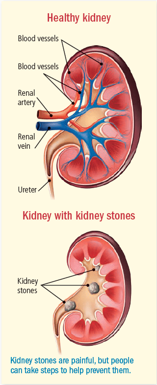 Kidney Stones: Symptoms and Treatment Options