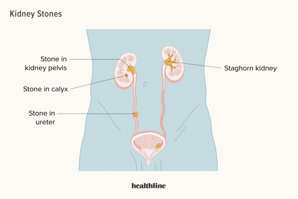 Kidney Stones: Symptoms and Treatment Options