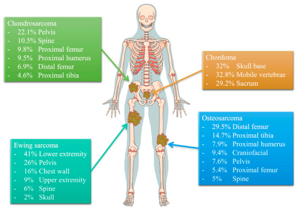 Latest Advances in Ewing Sarcoma Research