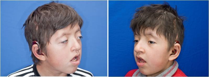 Latest Research Advances in Apert Syndrome