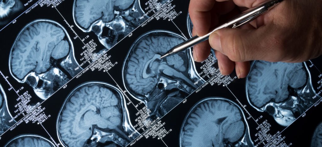 Latest Research on Brain Tumors