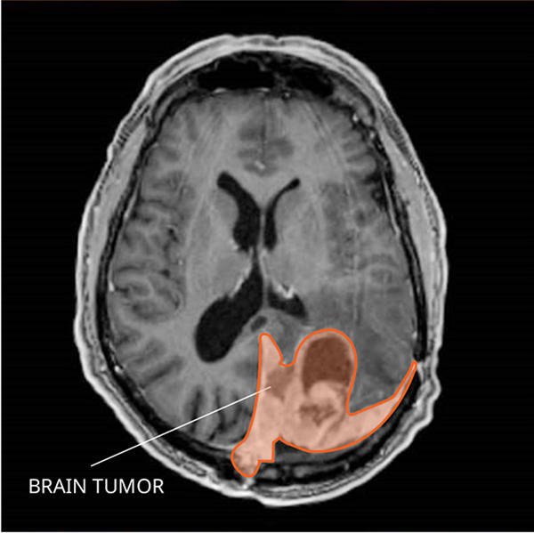 Latest Research on Brain Tumors