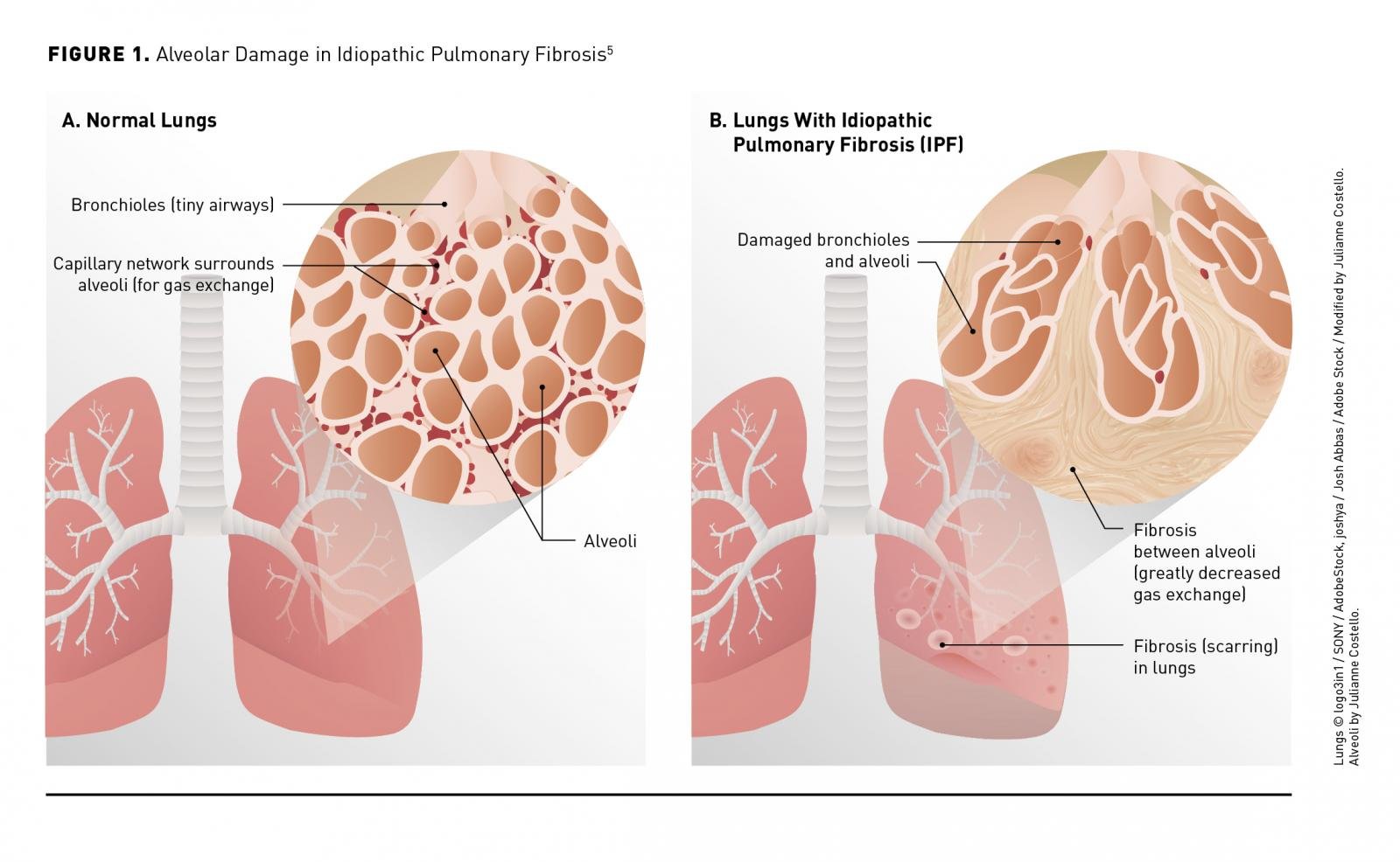 Ipf Image Latest Research On Idiopathic Pulmonary Fibrosis - Ask The Nurse Expert