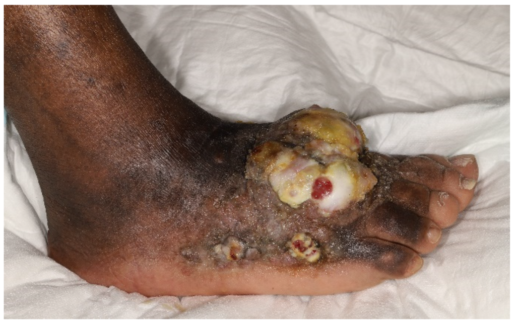 Latest Research on Kaposis Sarcoma: Promising Advances in Treatment
