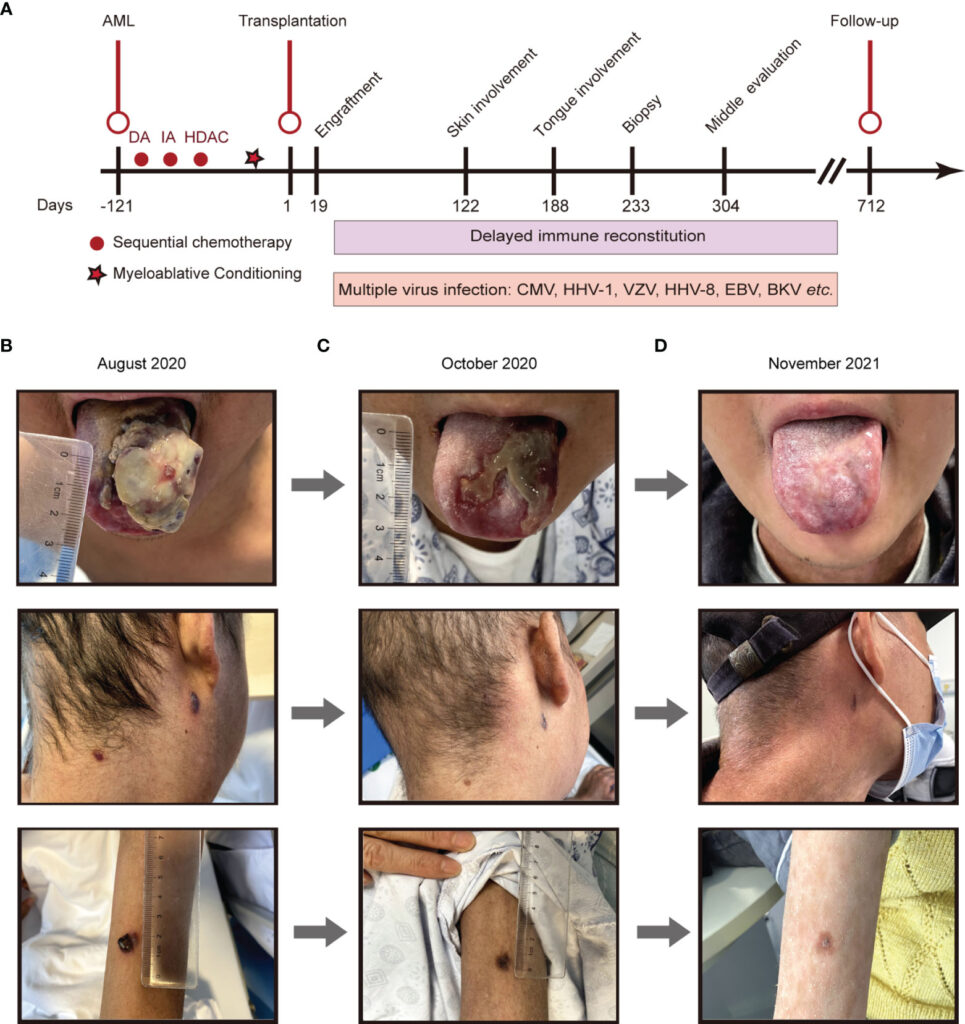 Latest Research on Kaposis Sarcoma: Promising Advances in Treatment