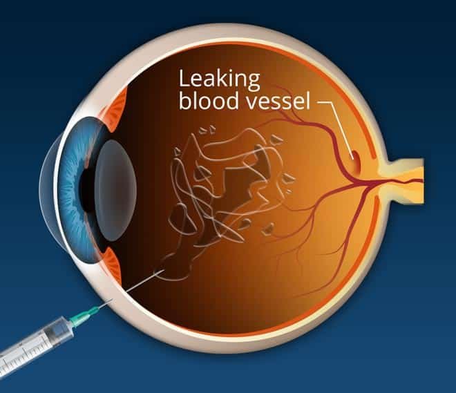 Latest Treatments for Macular Degeneration