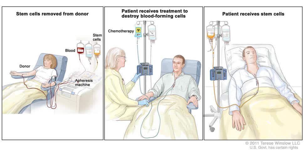 Leukemia Treatment Options: Chemotherapy, Radiation, and Stem Cell Transplant