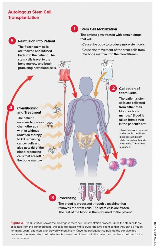 Leukemia Treatment Options: Chemotherapy, Radiation, and Stem Cell Transplant