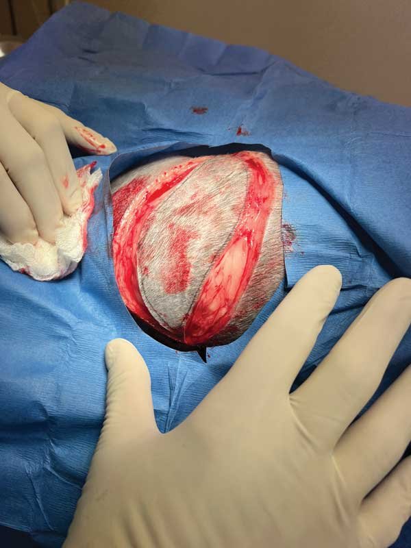 Lipoma Removal: Surgical Procedures and Aftercare